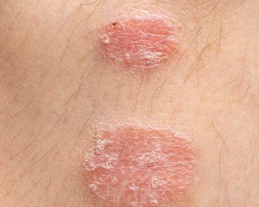 Ploques psoriatikoen itxura