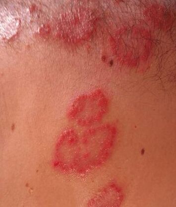 Psoriasia lekuak