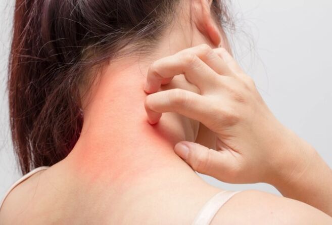 Azkura psoriasiaren arrazoietako bat da