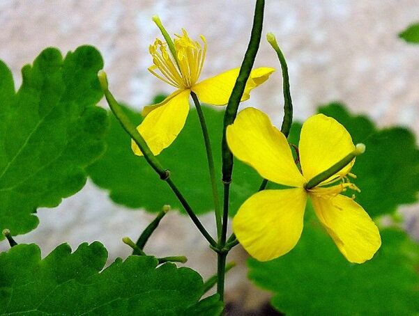 Celandine psoriasia tratatzeko