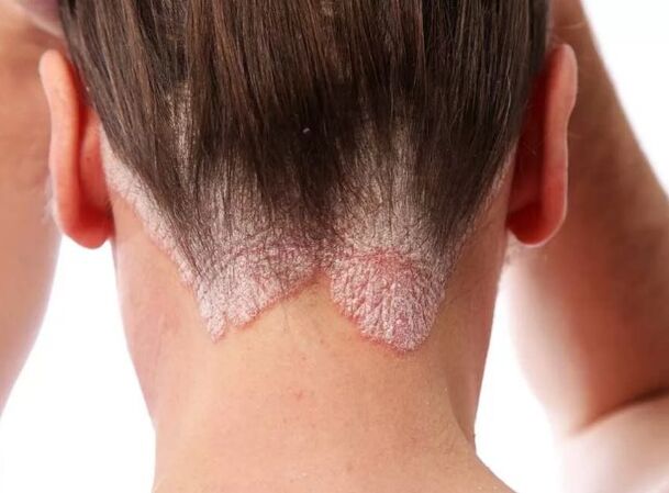 Eritroma psoriatikoa