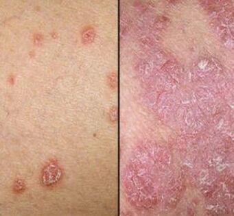 Ploques psoriatikoak