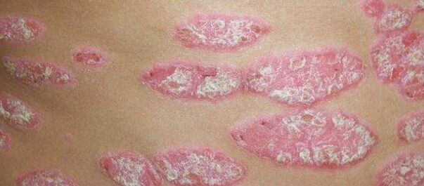 Psoriasiaren etapa progresiboa