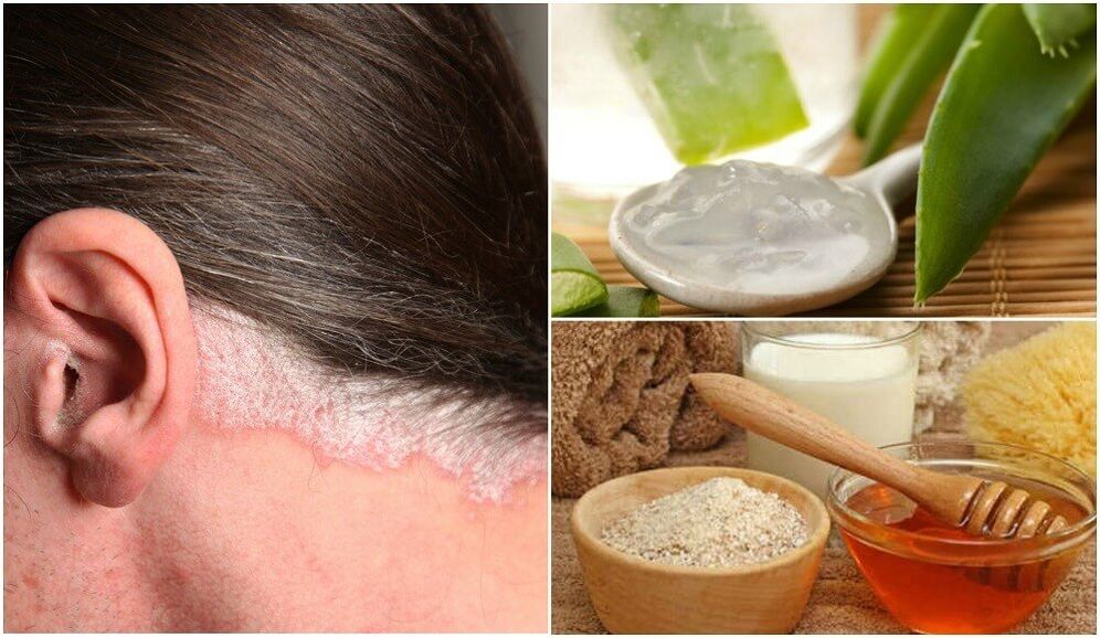 Psoriasia tratatzea folk erremedioekin
