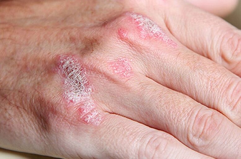 Ladomary-euste Psoriasia