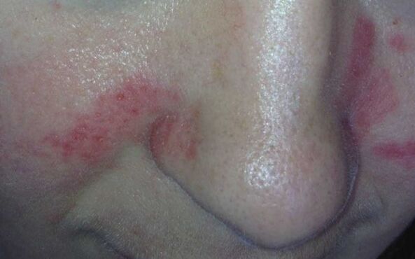 Psoriasia aurpegian sintomak
