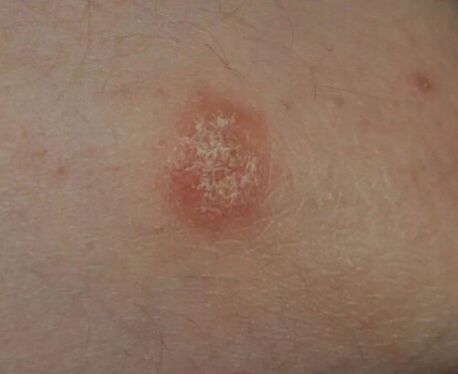 Psoriasia lekua