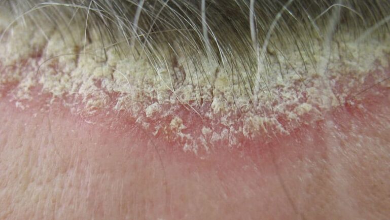 Scalp psoriasia