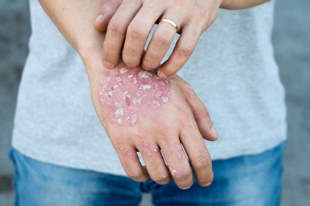 Psoriasia da