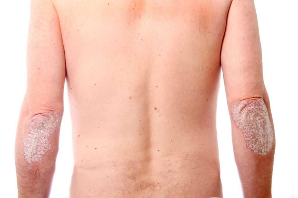 Psoriasiaren bigarren etapa