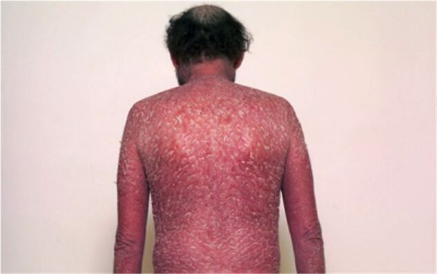 Psoriasiaren hirugarren etapa