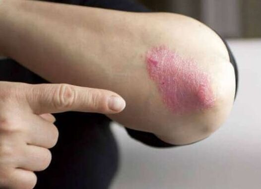Psoriasiaren etapa geldirik