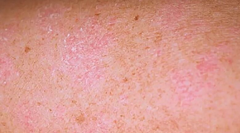 Psoriasiaren fase erregresiboa