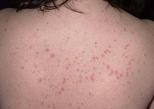 Psoriasiaren hasierako fasea