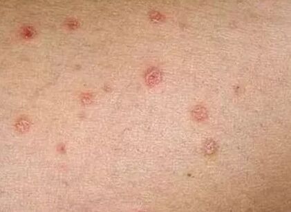 Hasierako fasearen psoriasia