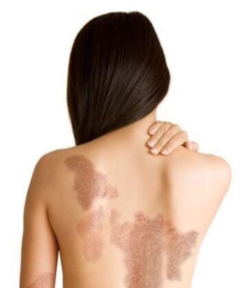 Psoriasia faseak lesioaren eremuaren arabera