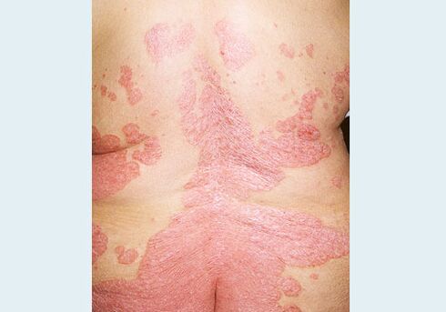 Atzeko psoriasia