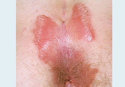 Itxi -Pinning psoriasia