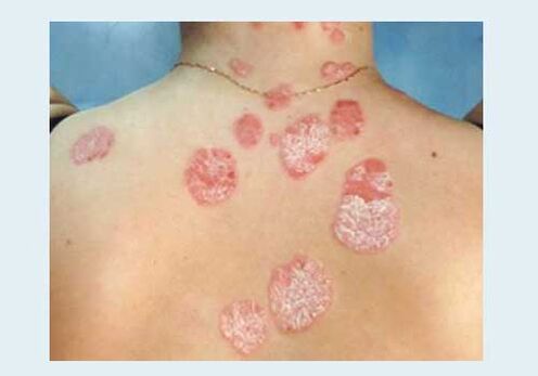 Psoriasia arrunta