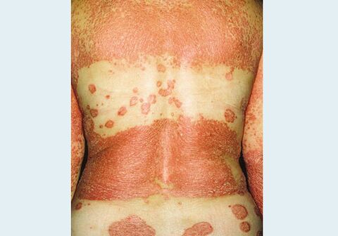 Psoriasia genitala