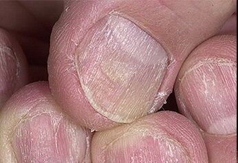 Iltzeen psoriasia
