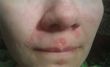Psoriasia aurpegian