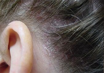 Psoriasia buruan