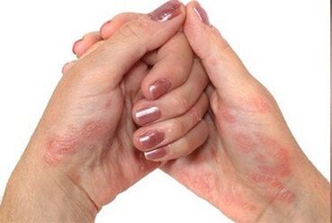 Psoriasia eskuetan
