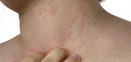 Psoriasia lepoan