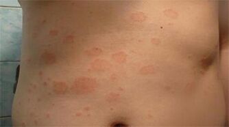 Psoriasia sabelean