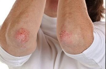 Psoriasia ukondoetan