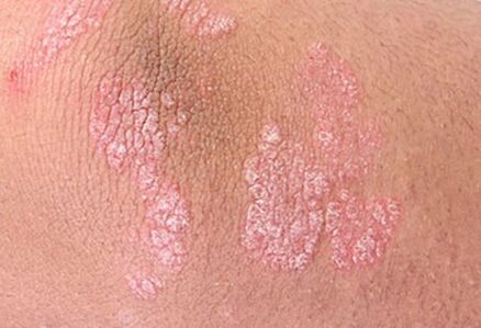 psoriasia