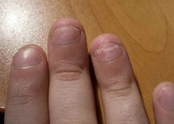 Iltzeen psoriasia