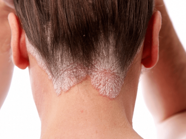 Psoriasia buruan
