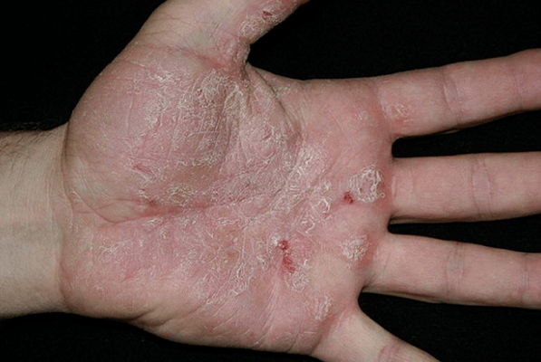 Psoriasia eskuetan