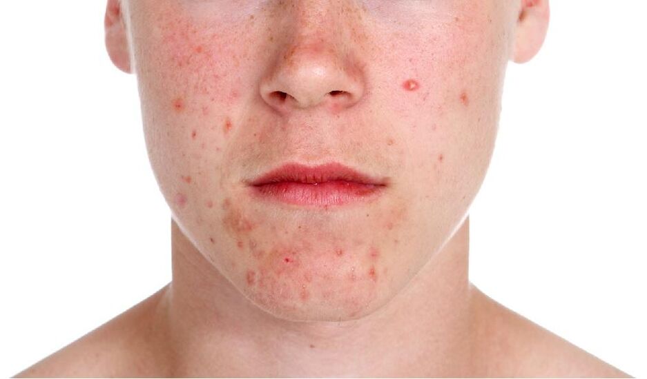 Psoriasia aurpegian