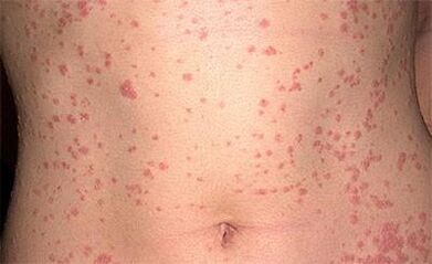 Psoriasia gorputzean