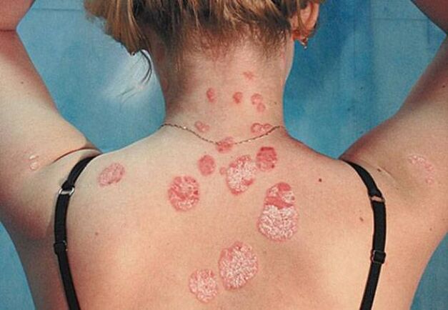 Psoriasia atzeko aldean