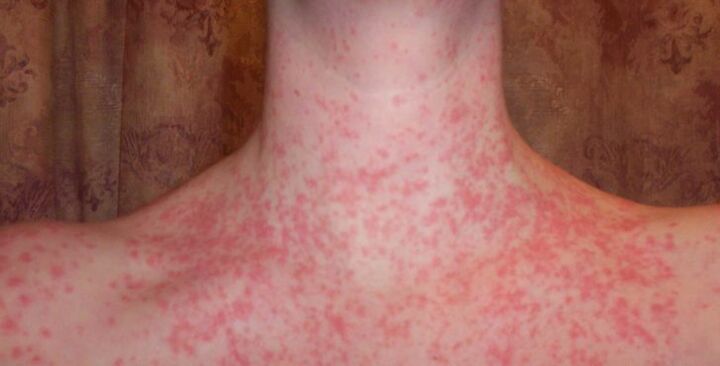 Psoriasia gorputzean