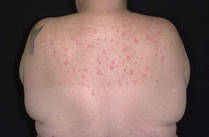 Psoriasia sorbaldetan