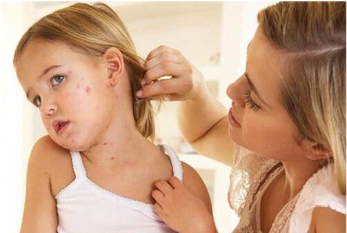 Psoriasiaren hasierako fasearen argazkia