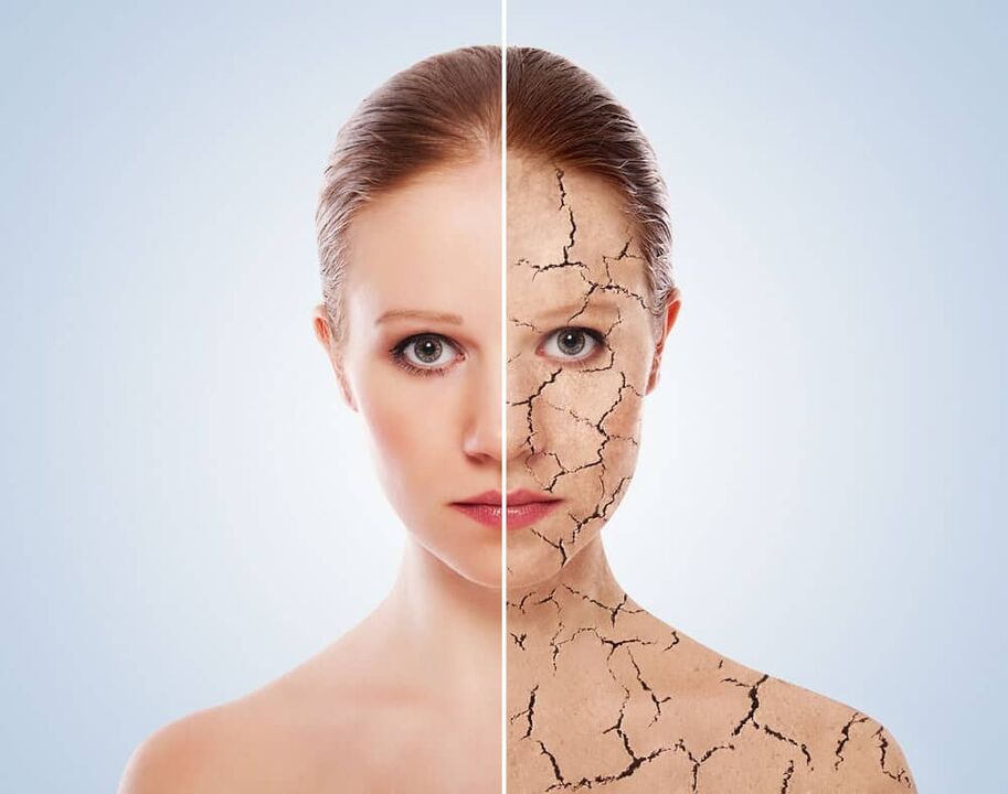 Larruazal osasuntsua eta psoriasia kaltetutako azala