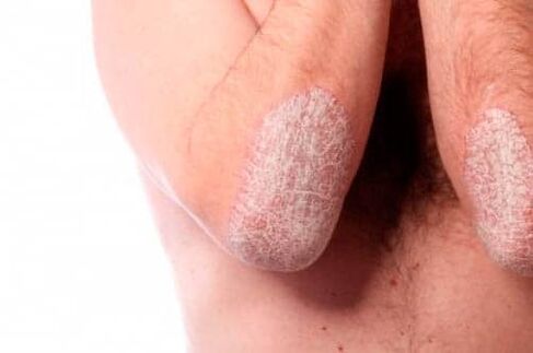 Psoriasia ukondoetan