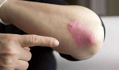 psoriasia garapenaren fase geldikorrean