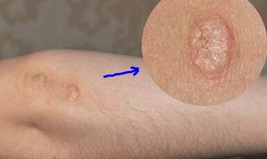 psoriasia garapenaren faseak