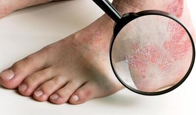 psoriasia tratamendu aukerak