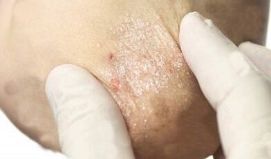 psoriasia tratamendua attenuation fasean