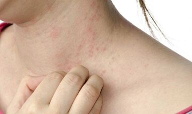 psoriasia tratamendua etapa aurreratuan