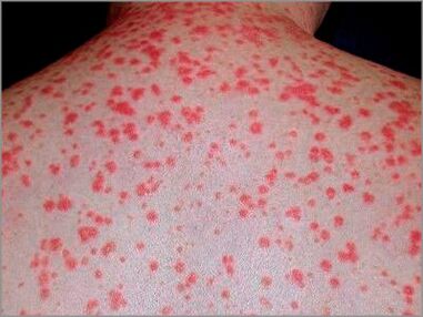 Guttate psoriasia