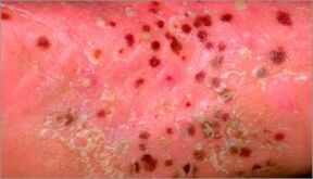 Psoriasia pustularra